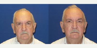 Dermal Fillers before and after photo