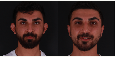 Ear Surgery before and after photo