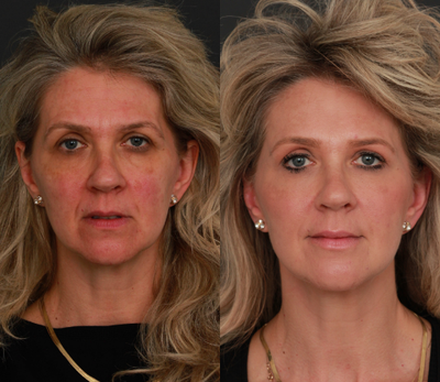 Juvederm before and after photo