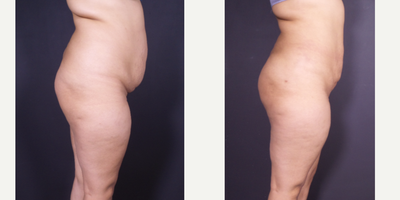 Brazilian Butt Lift before and after photo