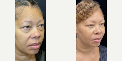 Eyelid Surgery before and after photo