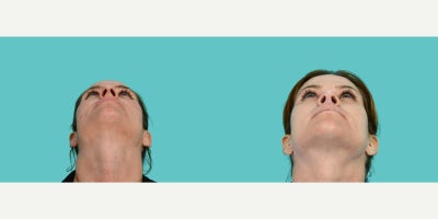 Facelift before and after photo