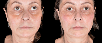 Restylane Lyft before and after photo