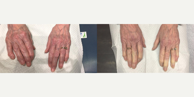 Skin Rejuvenation before and after photo