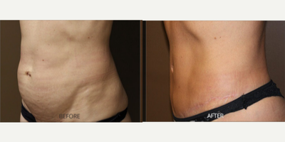 Tummy Tuck before and after photo