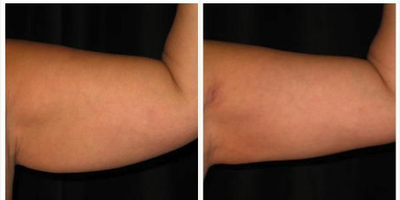 Arm Lift before and after photo