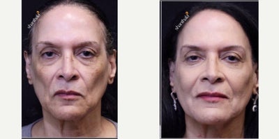before and after image