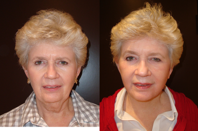 Facelift before and after photo