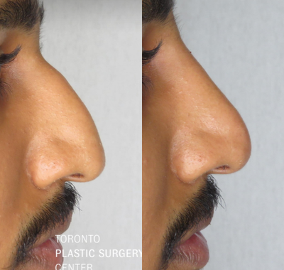 Nonsurgical Nose Job before and after photo