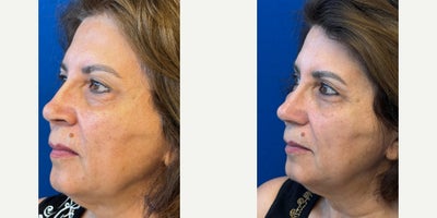 before and after image