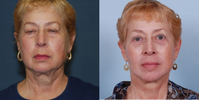 Facelift before and after photo