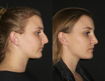 Rhinoplasty before and after photo