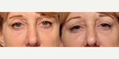 Belotero before and after photo