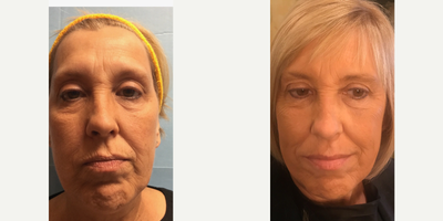 Dermal Fillers before and after photo