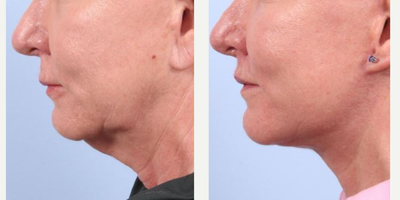 Facelift before and after photo