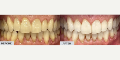 Invisalign before and after photo