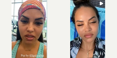 PRP Injections before and after photo
