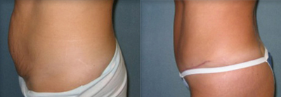 Tummy Tuck before and after photo