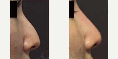 Voluma before and after photo