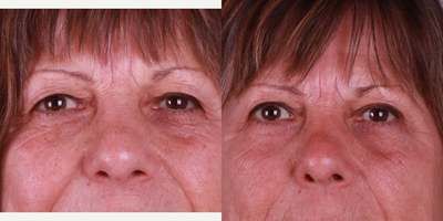 Eyelid Surgery before and after photo