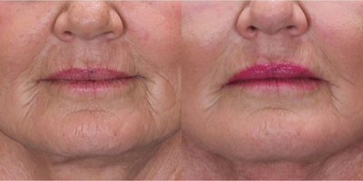 FaceTite before and after photo
