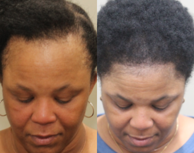 NeoGraft before and after photo