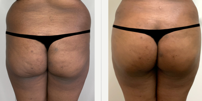 Nonsurgical Butt Lift before and after photo