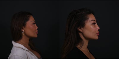 Revision Rhinoplasty before and after photo