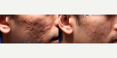 Scar Removal before and after photo