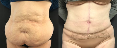 Tummy Tuck before and after photo