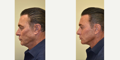 Chin Liposuction before and after photo