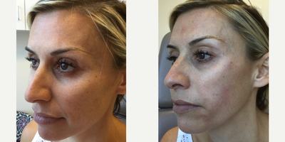 Dermal Fillers before and after photo