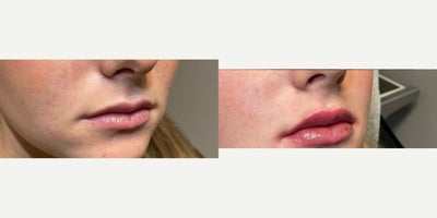 Dermal Fillers before and after photo