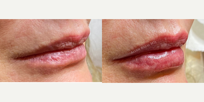 Lip Fillers before and after photo