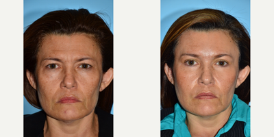 Eyelid Surgery before and after photo