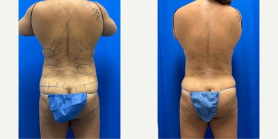Liposuction before and after photo