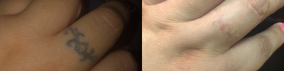 Tattoo Removal before and after photo