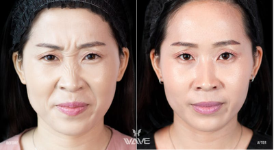 Botox before and after photo