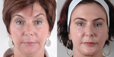 Chin Implant before and after photo