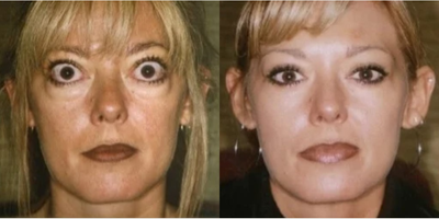 Eyelid Surgery before and after photo