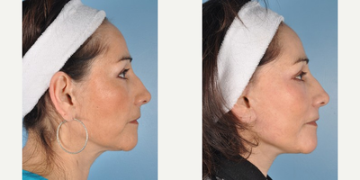 Facelift before and after photo