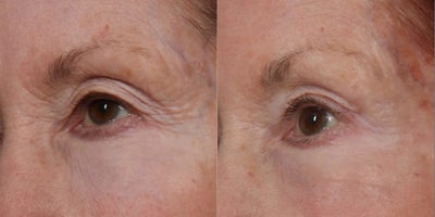 Brow Lift before and after photo