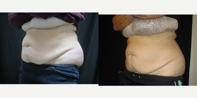 CoolSculpting before and after photo