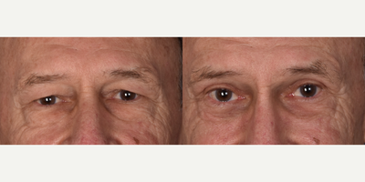 Eyelid Surgery before and after photo