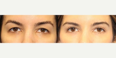 Eyelid Surgery before and after photo