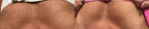 IPL before and after photo