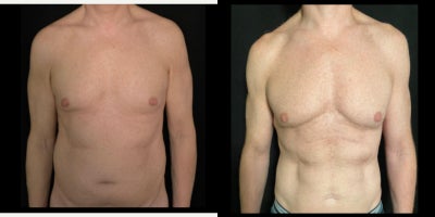 Abdominal Etching before and after photo