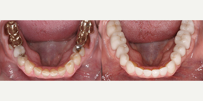Dental Crown before and after photo