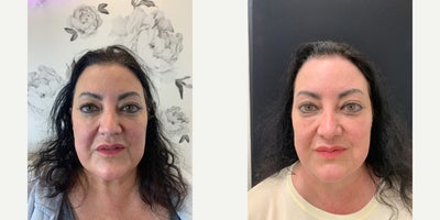 Dermal Fillers before and after photo