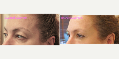 Eyelid Surgery before and after photo